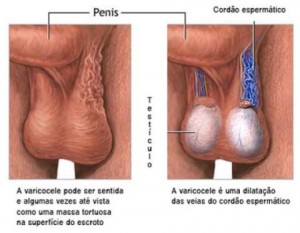 Varicocele